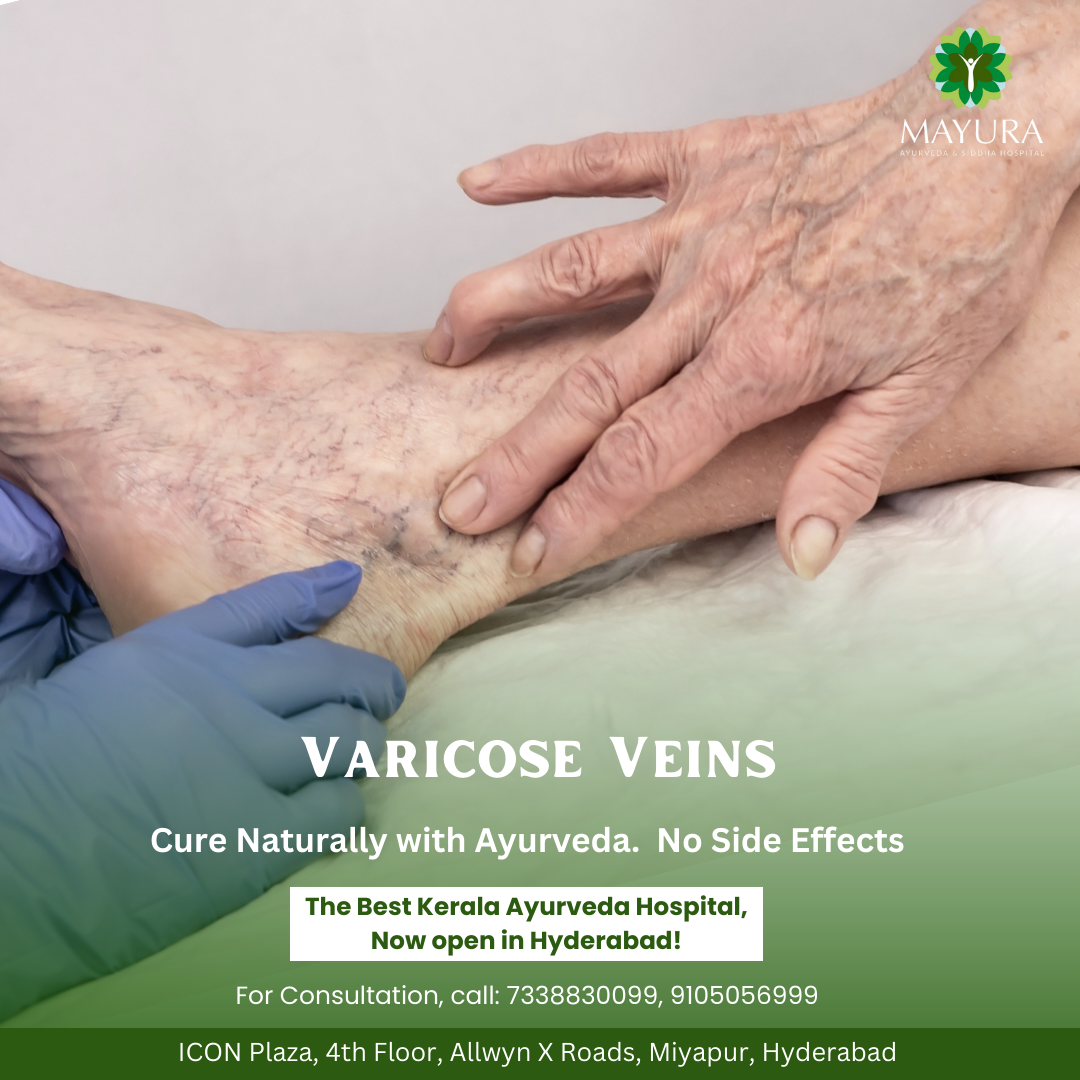 Varicose Veins