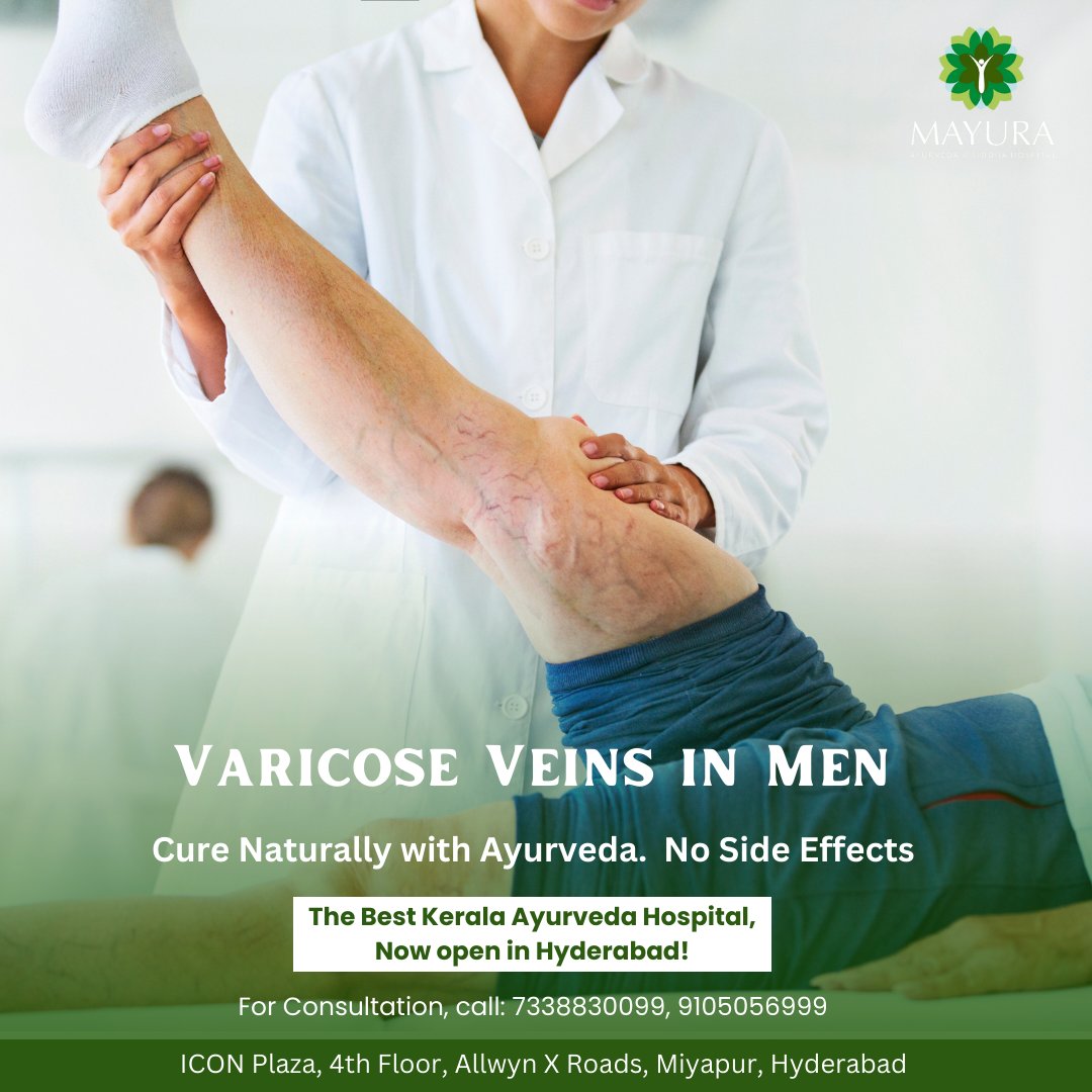 Varicose Veins in Men